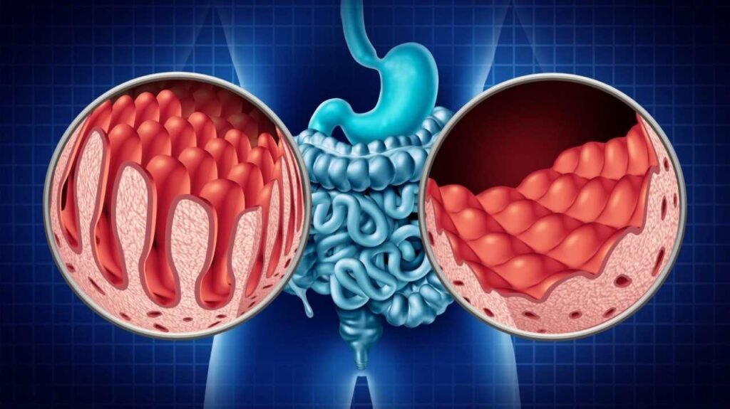 Celiac Disease