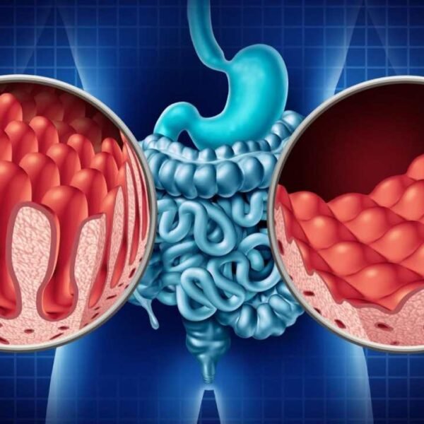 Understanding Celiac Disease: Causes, Symptoms, and Treatment